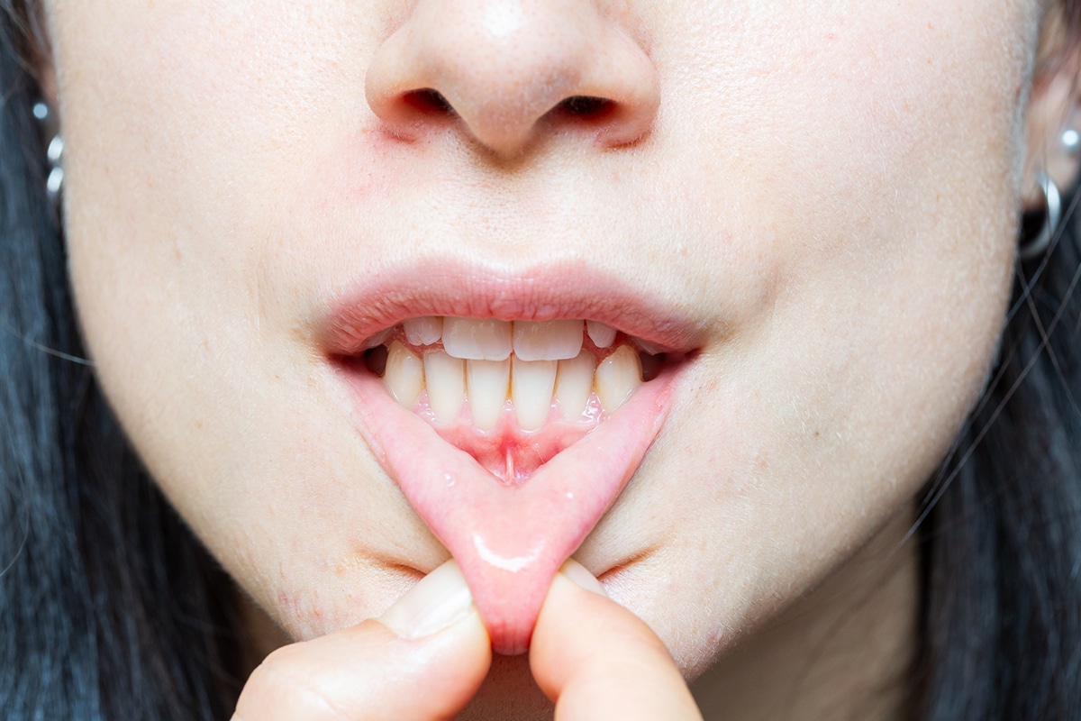 Identifying and treating your gum recession blog