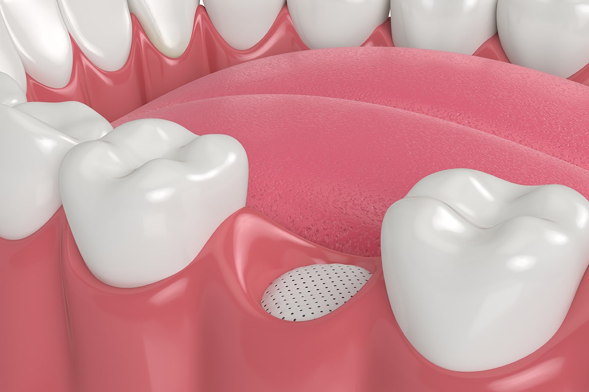 Importance of bone grafting in dental implant procedures blog