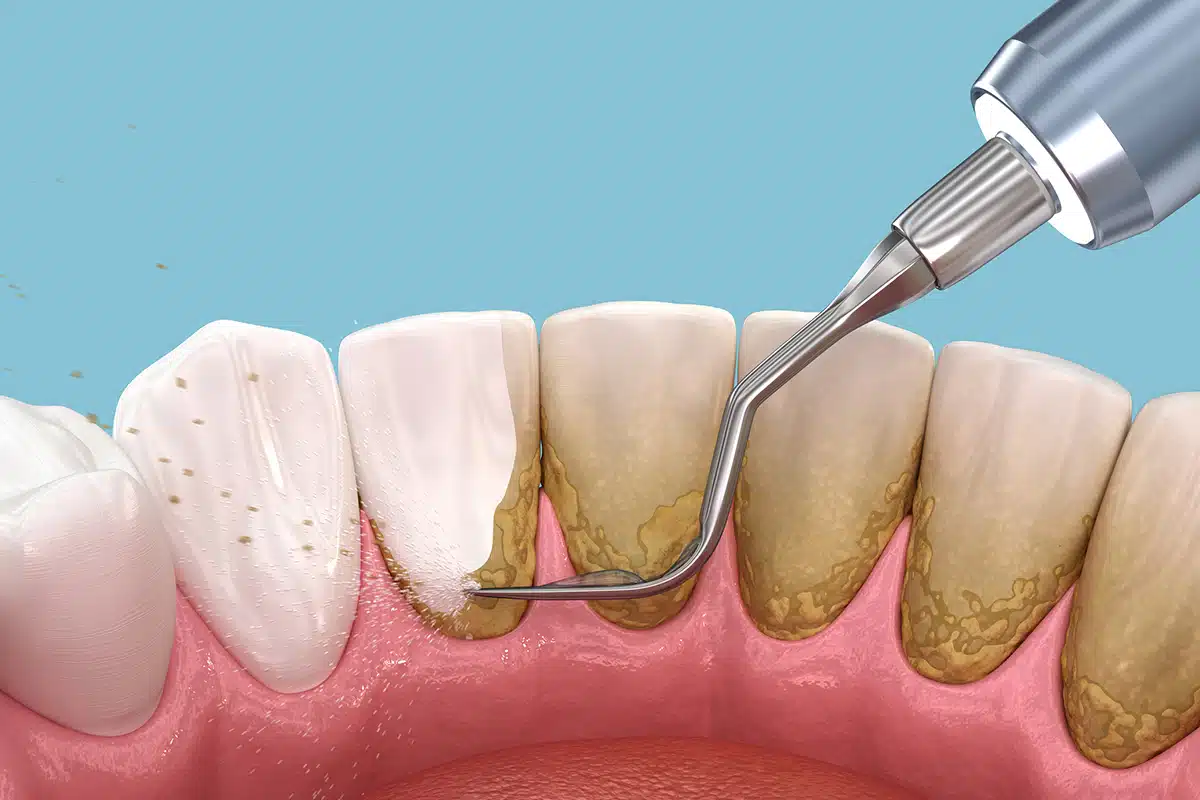 Periodontal cleanings vs regular cleanings key differences blog